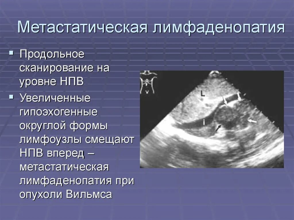 Ворота лимфатического узла на УЗИ. Лимфоузлы в воротах печени на УЗИ. Метастатическая лимфаденопатия. Метастатические лимфоузлы на УЗИ. Увеличенные лимфоузлы в печени