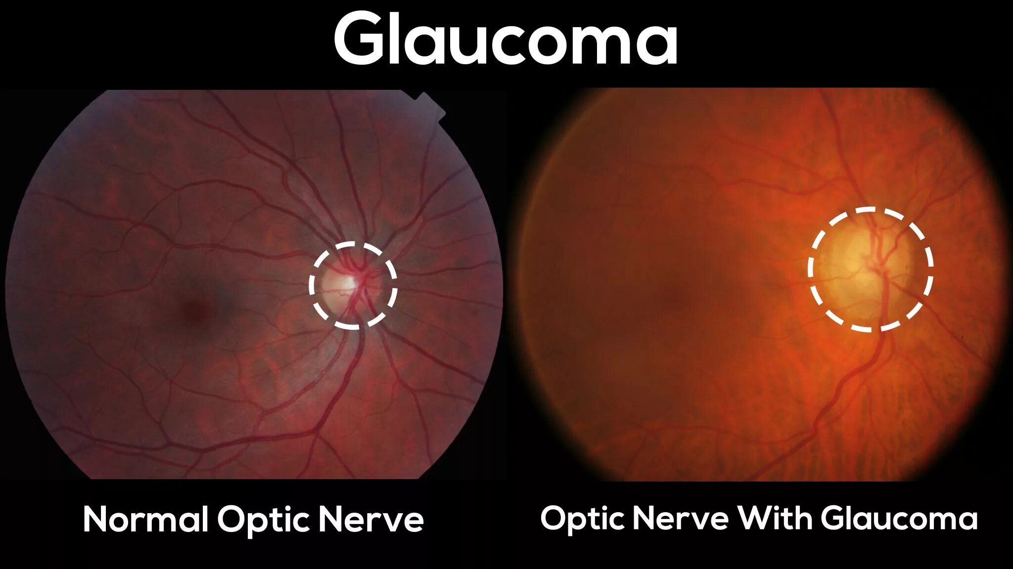 Зрительный нерв при глаукоме. Дистрофическая вторичная глаукома. Факотопическая глаукома.