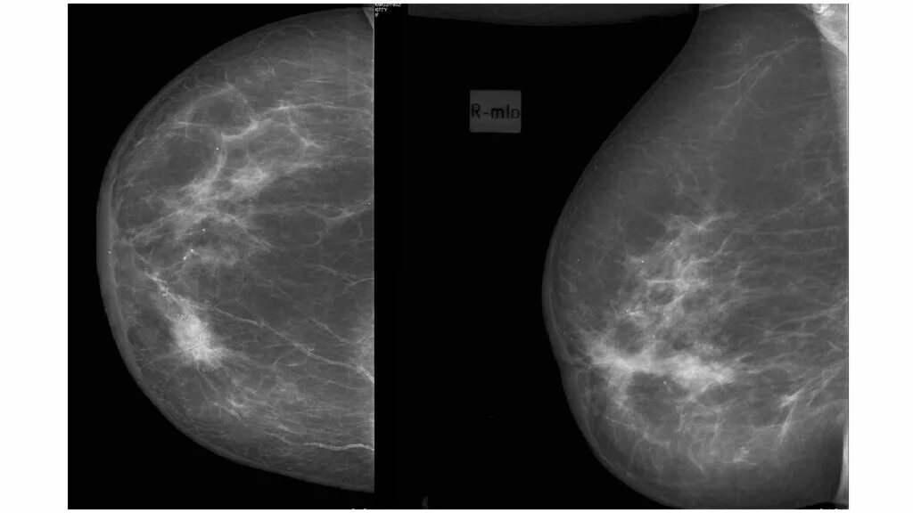Шишка в грудной железе у женщин. Диффузный фиброаденоматоз. Опухоль молочной железы маммограмма. Рик молочной железы маммографич. Диф фиброаденоматоз молочных желез.