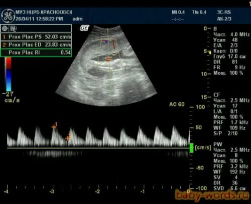 Как делают доплер. Допплерометрия маточно-плацентарно-плодового кровотока нормы. УЗИ допплерография маточно-плацентарного кровотока. Допплер маточного кровотока нормы. УЗДГ беременных (допплерометрия).