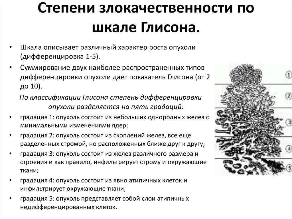 Стадии предстательной железы прогноз. Классификация Глисон предстательной железы. Классификация РПЖ шкала Глисона. Морфологическая классификация по шкале Глиссона. Шкала Глисона предстательной железы.