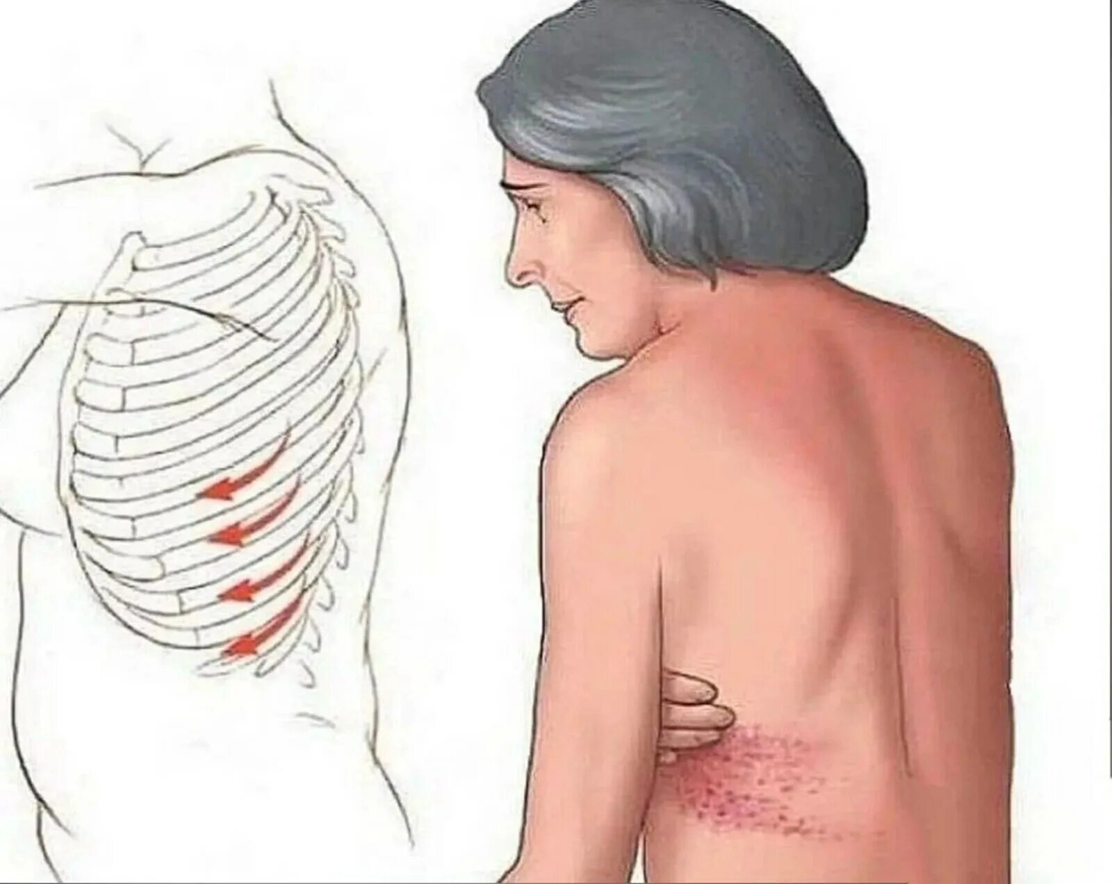 Болит поясница под ребрами. Опоясывающий лишай межреберная невралгия. Herpes zoster (опоясывающий лишай). Опоясывающий герпес межреберный. Герпес зостер межреберная невралгия.