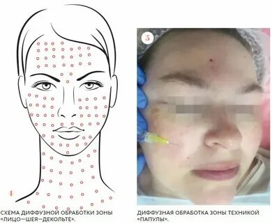 Точки мезотерапии