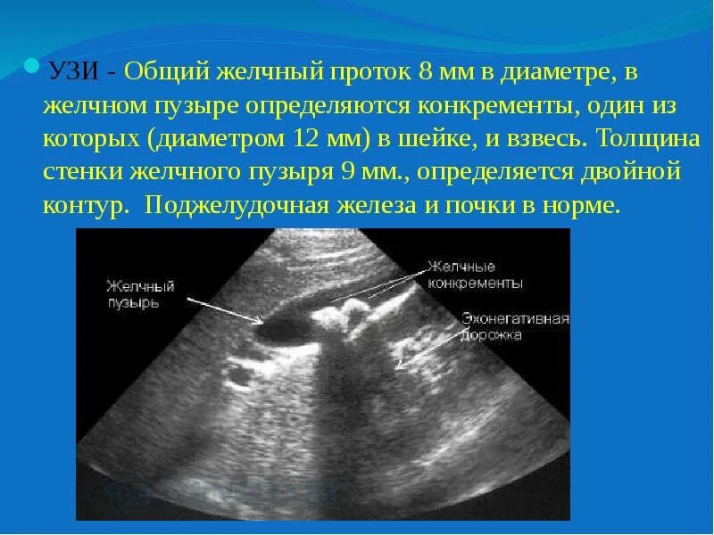 Толщина стенки желчного пузыря на УЗИ. Диаметр желчных протоков в норме УЗИ. Стенка желчного пузыря норма на УЗИ. Уплотнение стенок желчных протоков печени УЗИ.