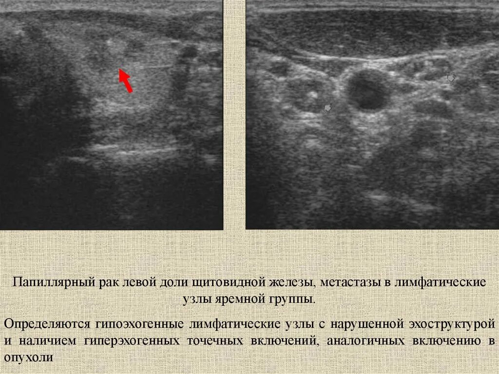 Карцинома щитовидной железы УЗИ. Фолликулярные узлы щитовидной железы УЗИ. Лимфатический узел щитовидной железы УЗИ. Губчатый узел щитовидной железы на УЗИ. Метастатические лимфоузлы