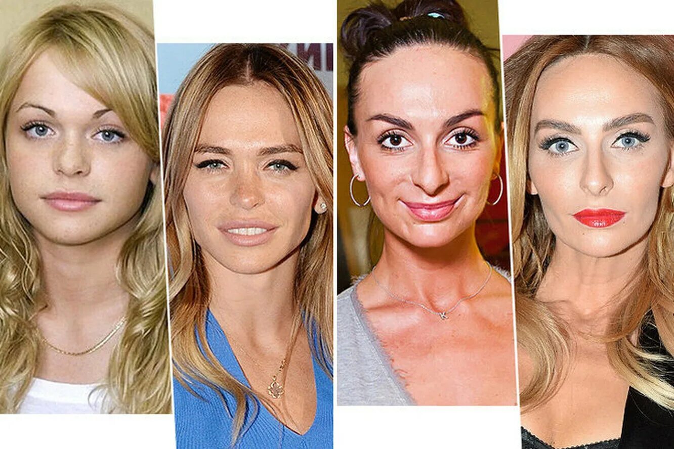 операция на скулы. меган фокс пластика губ. сделать скулы операция. сделать скулы операция. натали портман комки биша.