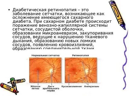 Диабетическая ретинопатия симптомы