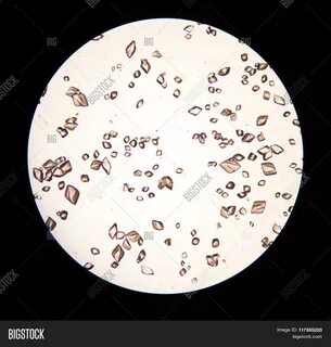 Кислота в моче