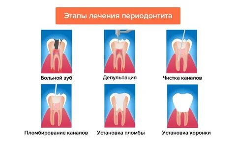 Периодонтит лечение