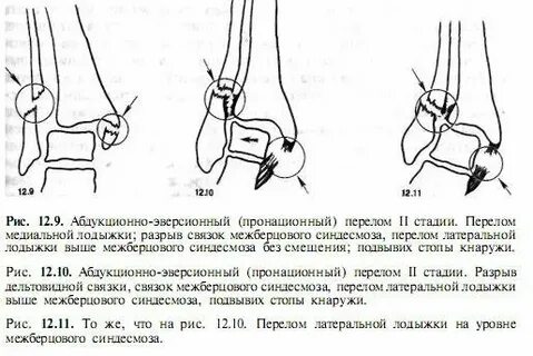 Срок лечения перелома лодыжки