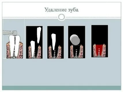 1 операция удаления зуба