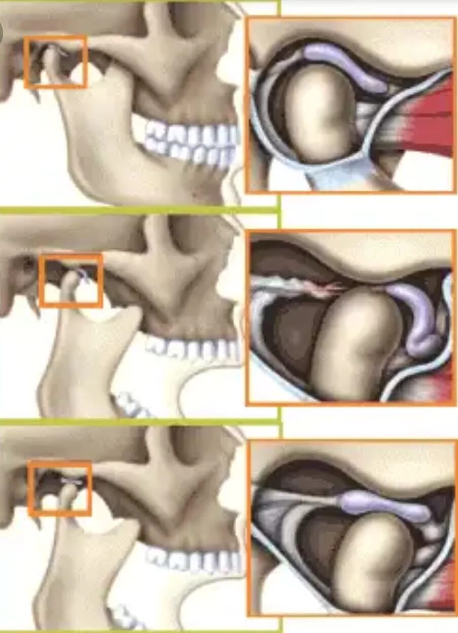 Щелкает челюсть при открытии рта что делать
