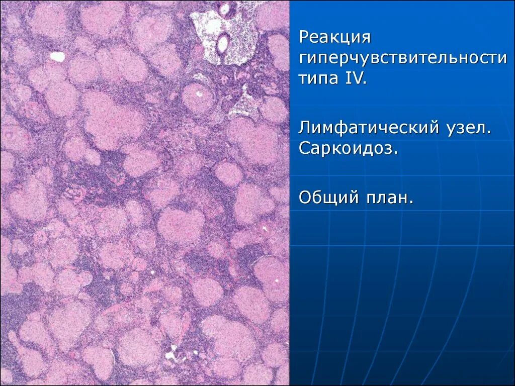 Саркоидная гранулема морфология. Саркоидоз лимфатических узлов. Гранулема саркоидного типа. Саркоидная гранулема