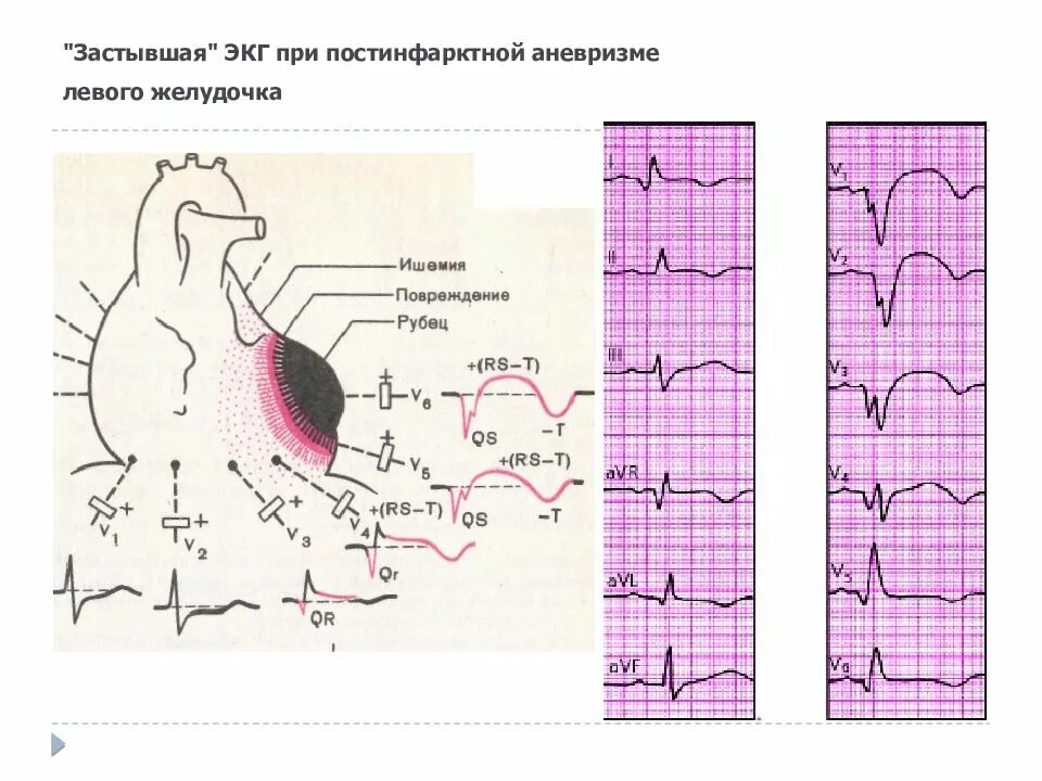 Очаговые изменения левого желудочка. Аневризма левого желудочка на ЭКГ. Для постинфарктной аневризмы лж характерно на ЭКГ. Инфаркт миокарда с аневризмой ЭКГ. ЭКГ при аневризме левого желудочка.