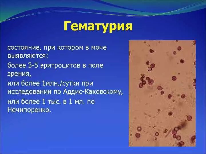 Сколько эритроцитов в моче. Эритроциты в поле зрения в моче. Эритроциты в моче 1-2. Сплошь эритроциты в поле зрения в моче это. Эритроциты в моче в поле зрения норма.