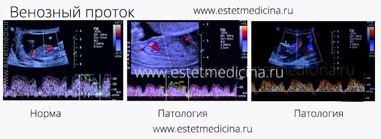 Сма плода. Венозный проток Pi норма 13 недель. Pi в венозном протоке 13 недель норма. Венозный проток УЗИ допплер. Допплерометрия венозного протока норма.