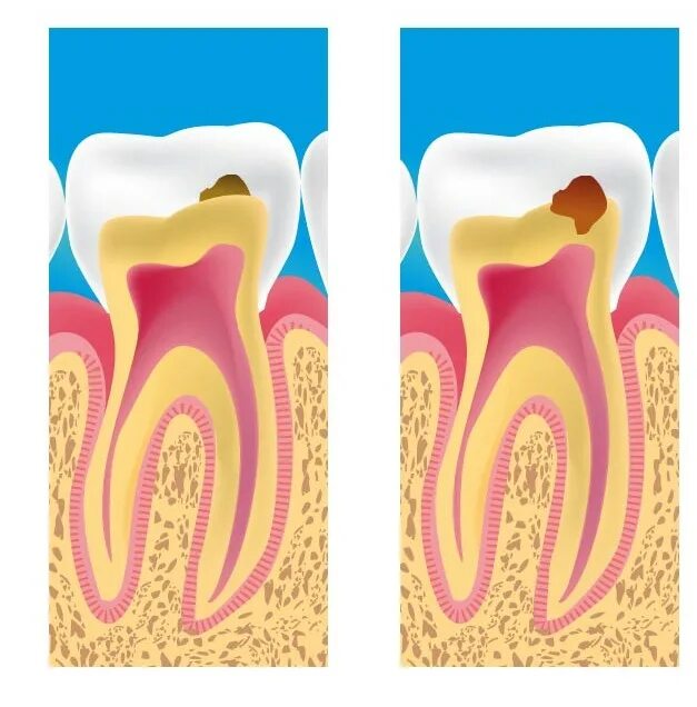 Осложнения лечения кариеса. Кариес пульпит периодонтит. Гипертрофический пульпит. Осложненный кариес зуба пульпит периодонтит.