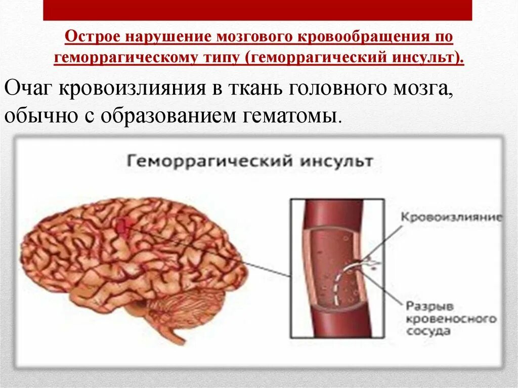 Хронические нарушения мозгового кровообращения классификация. Инсульт острое нарушение мозгового кровообращения. Нарушение мозгового кровообращения по геморрагическому типу. Острым нарушение кровообращение мозга. Острое мозговое кровообращение ишемического нарушения