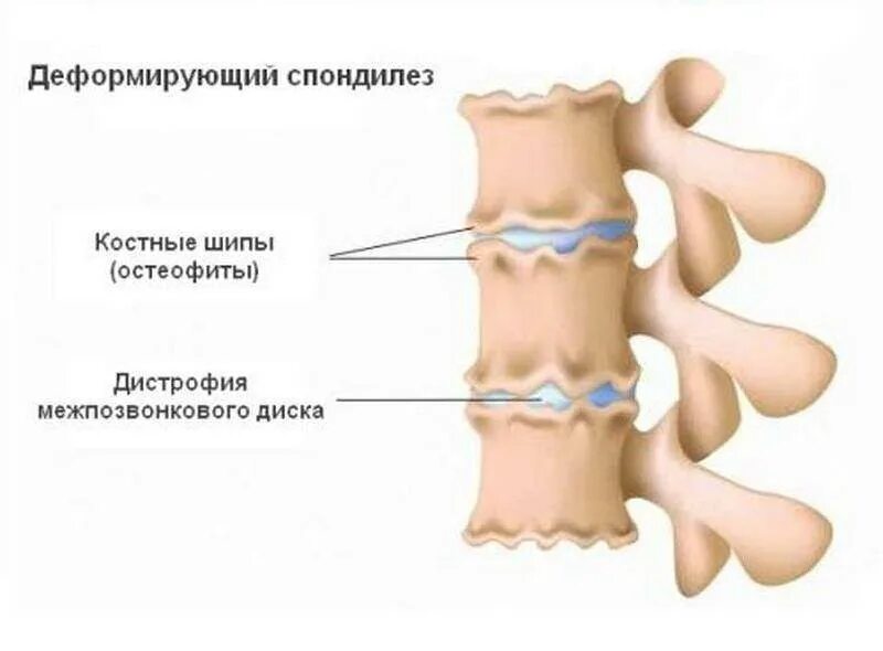 Остеофиты что это такое и как лечить. Деформирующий спондилез l2 l5. L1-l4 деформирующий спондилез. Спондилез пояснично-крестцового отдела позвоночника. Остеохондроз деформирующий спондилоартроз и спондилёз.