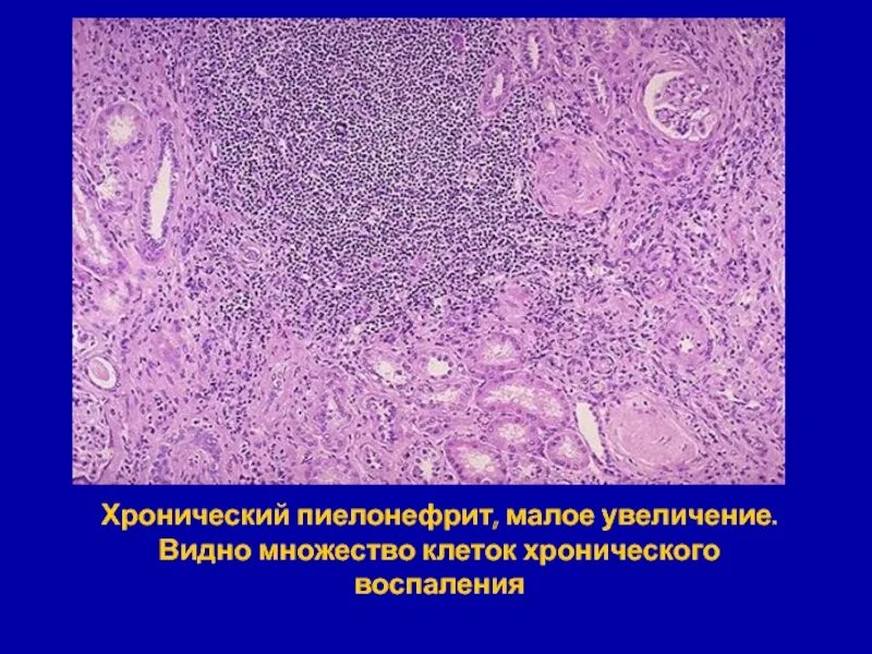 История хронического пиелонефрита. Апостематозный нефрит патанатомия. Пиелонефрит патанатомия макропрепарат. Хронический пиелонефрит патанатомия препарат. Хронический пиелонефрит нефроцирозз патанат.