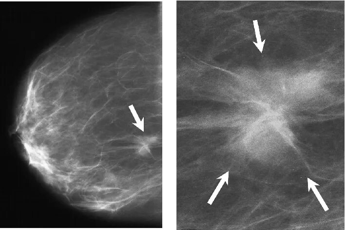 Диффузно фиброзная мастопатия bi rads 2. Фиброзно кистозная мастопатия маммограмма. Фиброаденома молочной железы маммограмма. Bi rads 4 б маммография. Склерозирующий аденоз.