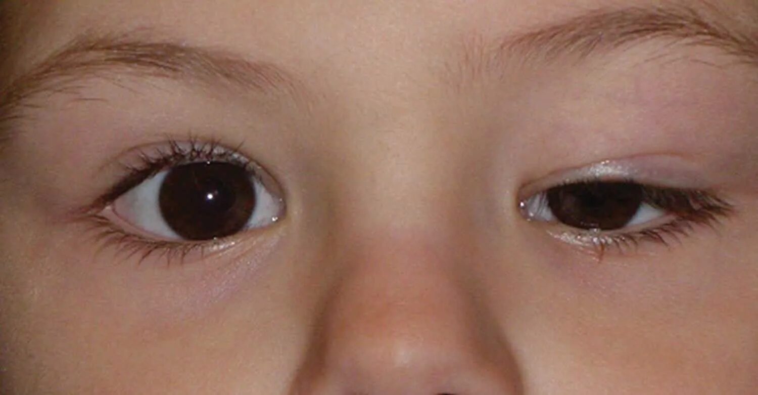 Глаза стали разного. Врожденный блефароптоз. Птоз век офтальмология.