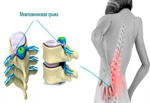 Грыжи поясничного отдела позвоночника у женщин. Межпозвоночная грыжа поясничного отдела. Грыжа грудного отдела позвоночника. Межпозвонковые грыжи грудного отдела позвоночника. МТР грыжа поясничного отдела позвоночника.
