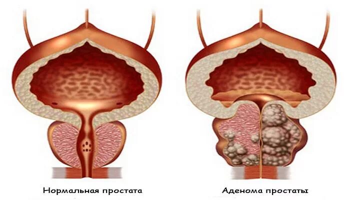 Хроническая простата аденома. Аденома предстательной железы (аденома простаты). Доброкачественная гиперплазия предстательной железы. Доброкачественная гипертрофия простаты.
