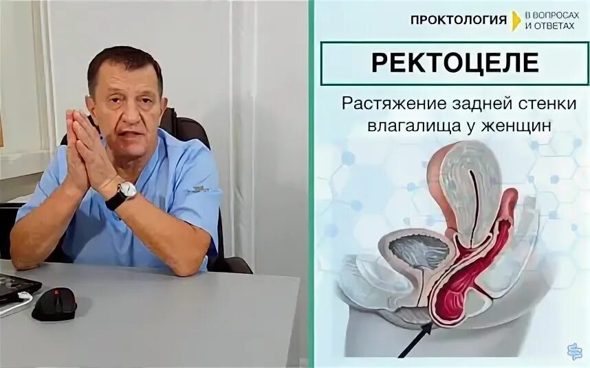 Ректоцеле что это такое у женщин