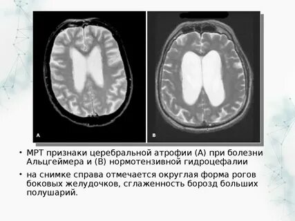 Признаки наружной гидроцефалии у взрослых