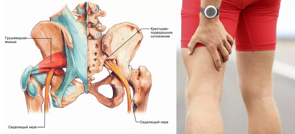 Ущемление тазобедренного сустава. Крестцово-подвздошное сочленение и седалищный нерв. крестец седалищный нерв. крестцово-подвздошный сустав ишиас. анатомия тазобедренного сустава седалищного нерва.