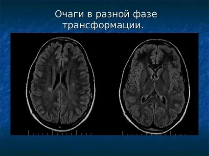 Демиелинизирующее заболевание
