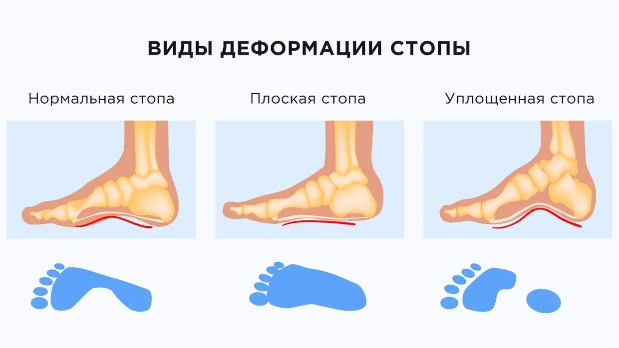 Москва деформация стопы