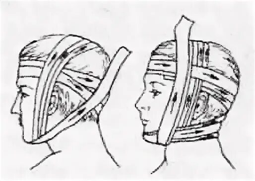 Десмургия повязка уздечка. Бинтовые повязки на шею техника. Повязки на голову в виде «Чепца» и «уздечки». Повязка в виде «уздечки» на теменную и затылочную области головы.. Повязка уздечка накладывается