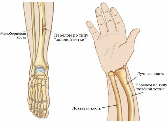 Перелом лучевой кости по типу зеленой веточки у детей. Зеленая веточка перелом лучевой кости. Перелом лучевой кости по типу зеленой веточки. Поднадкостничные переломы по типу зеленой веточки. Болят лучевые кости почему