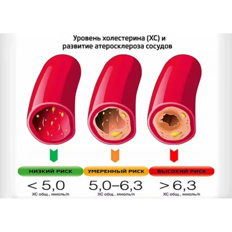 Снижение уровня холестерина в крови. Хороший уровень холестерина. Атеросклероз холестерин. Холестерин при атеросклерозе.