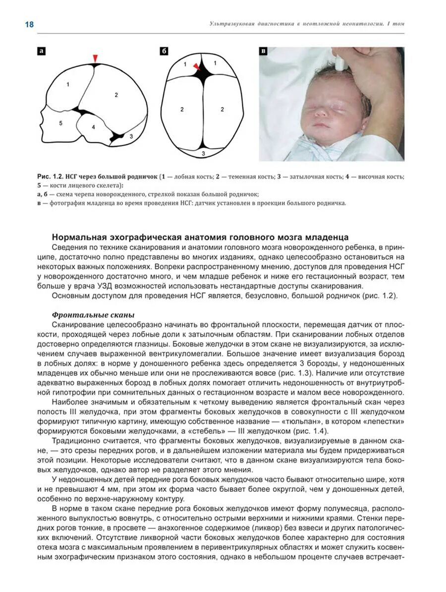 Расширение желудочков мозга у ребенка. УЗИ головного мозга нейросонография. Размеры желудочков головного мозга у новорожденных в 1 месяц норма. Норма размера желудочков мозга у детей 3 месяца. Нормы размеров желудочков головного мозга у детей.