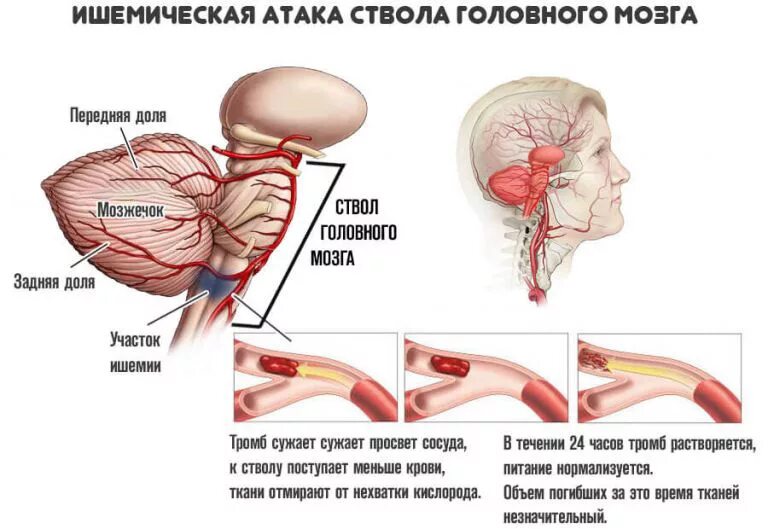 Имеет крови мозга и. Ишемического инсульта ствола мозга симптомы. Транзиторная ишемическая атака головного мозга симптомы. Инсульт ствола головного мозга. Ишемический инсульт ствола головного мозга.