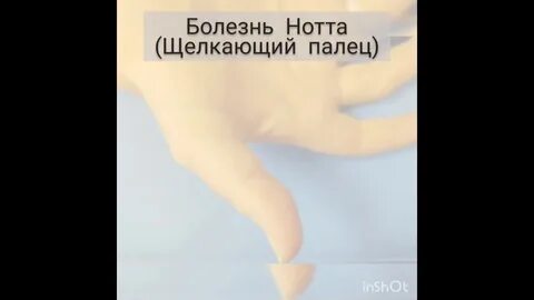 Палец нотта