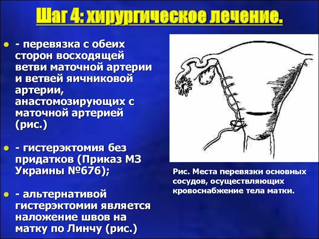 Перевязка маточных сосудов по Цицишвили. Перевязка маточных сосудов с обеих сторон. Перевязка восходящей ветви маточной артерии. Билатеральная перевязка маточных артерий. Перевязать трубы после родов