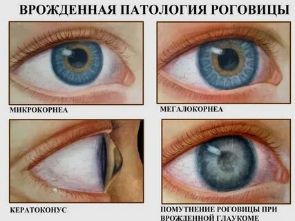 Аномалия роговицы