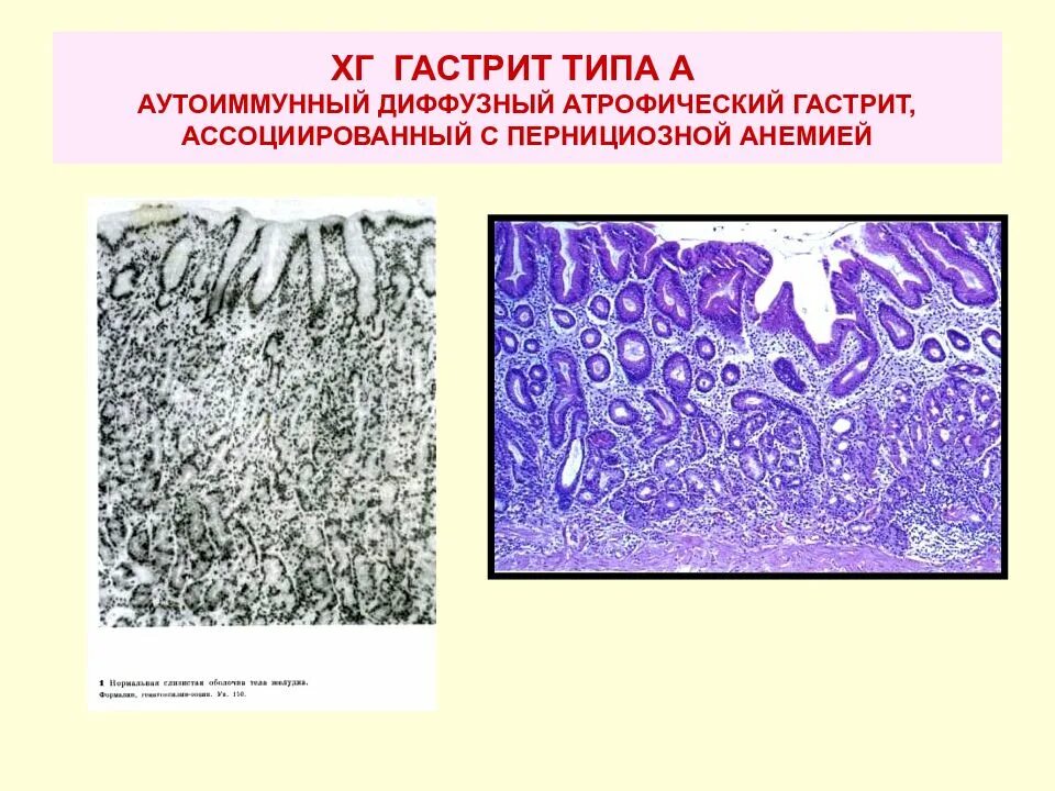 Диффузно атрофические изменения. Хронический аутоиммунный гастрит гистология. Диффузный атрофический гастрит. Аутоиммунный атрофический гастрит. Хронический атрофический гастрит микропрепарат.