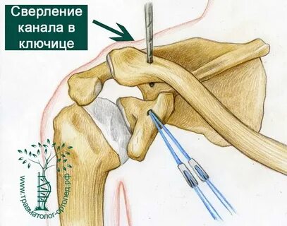 Вывих акромиального конца ключицы