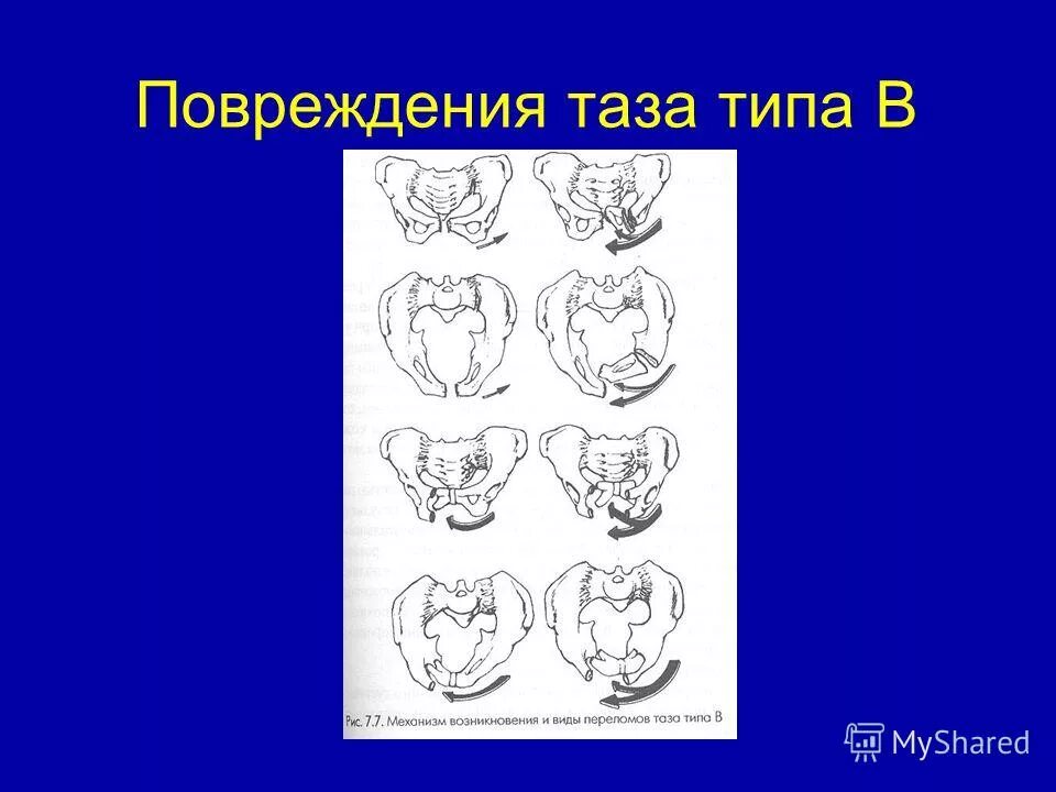 Простой плоский таз. Общеравномерно суженый таз. Формы анатомически узкого таза. Виды узкого таза таблица. Классификация таза в акушерстве.