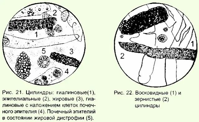 Гиалиновые цилиндры норма. Цилиндры в моче микроскопия. Восковидный цилиндр в моче микроскопия. Гиалиновый цилиндр и почечный эпителий. Цилиндр эпителий.