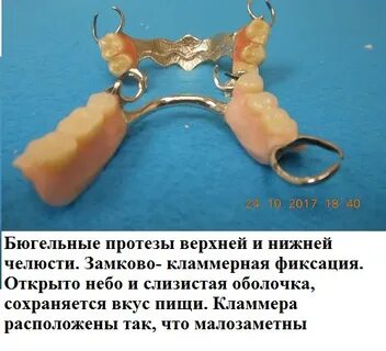 Изготовление бюгельного протеза с кламмерной фиксацией этапы