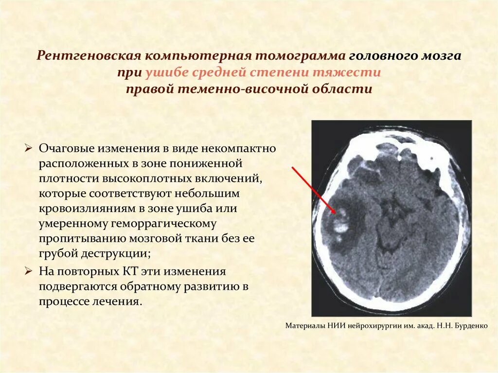 Многоочаговые поражения головного. Ушиб головного мозга средней степени кт. Ушиб головного мозга кт степени. Ушиб головного мозга легкой степени тяжести.