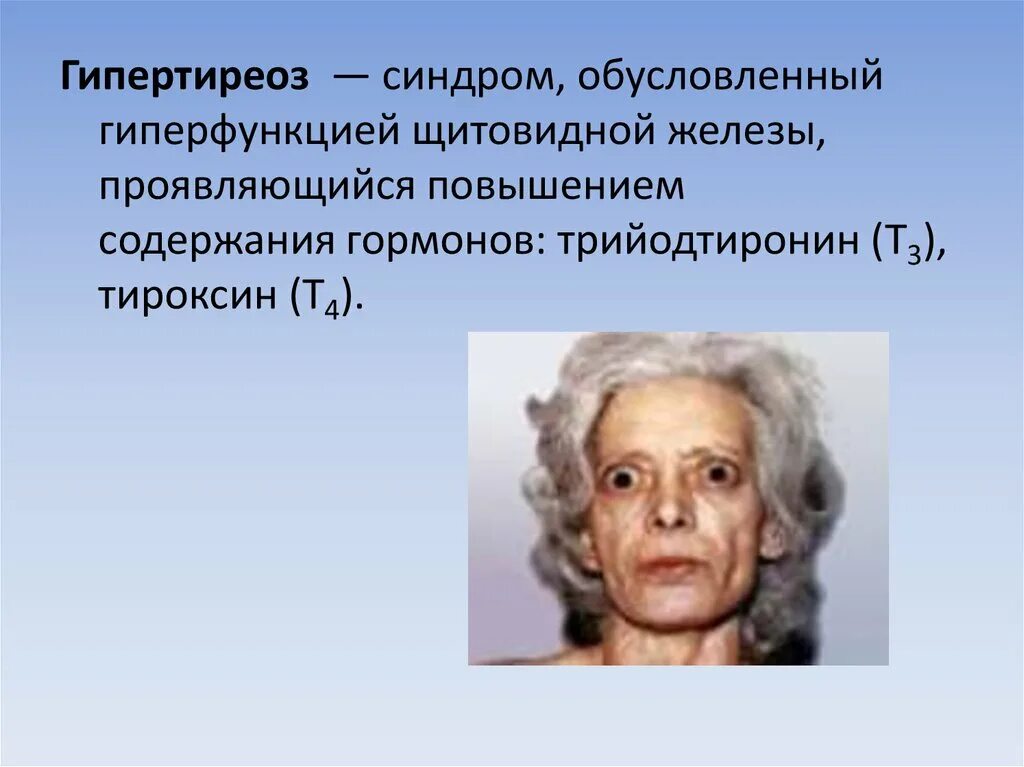 При гиперфункции щитовидной железы основной обмен. Тиреотоксикоз гиперфункция щитовидной железы. гиперфункция гормонов щитовидной железы. синдром гиперфункции щитовидной железы. щитовидная железа трийодтиронин гиперфункция.