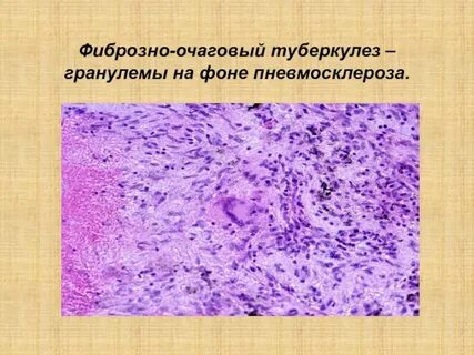Острый очаговый туберкулез