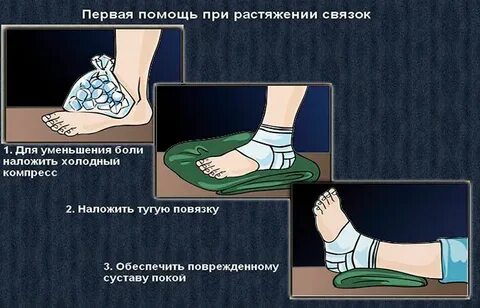 Что делать при растяжении ноги